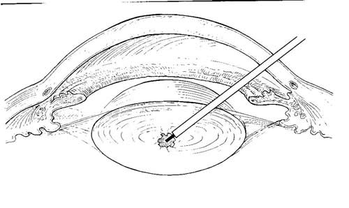 Lp_eye_sectional