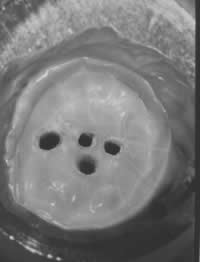precision_phacoablation_1